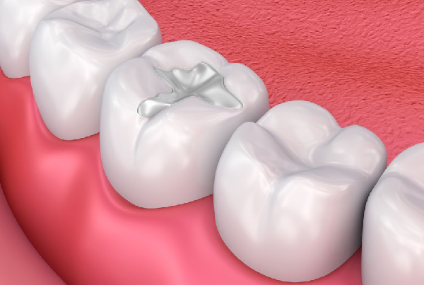 Dental Fillings