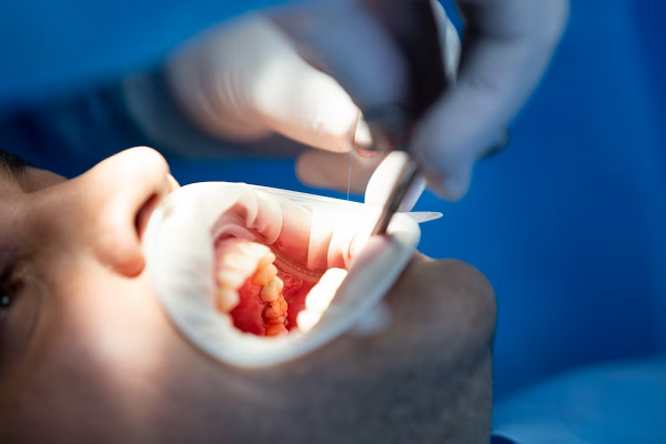 Dental Extraction