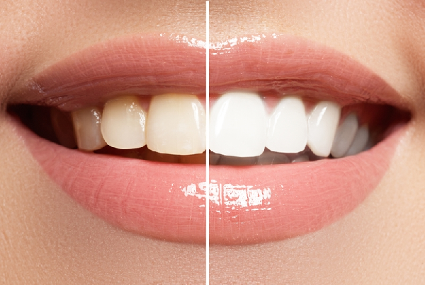 Dental Cleaning