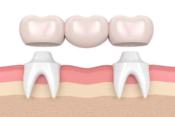 Fixed Partial Dentures